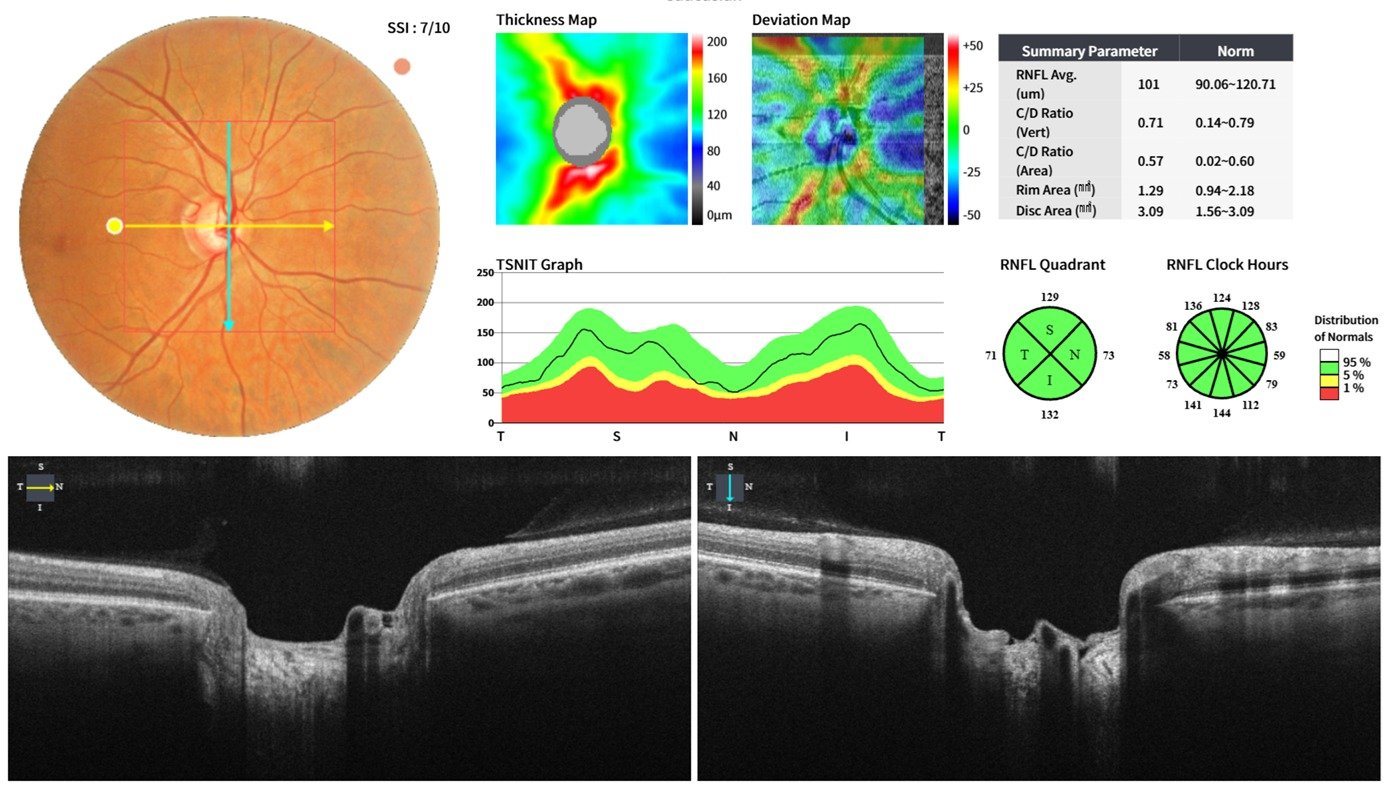 Informe de OCT de la capa de fibras nerviosas del nervio óptico utilizado en el diagnóstico y seguimiento del glaucoma