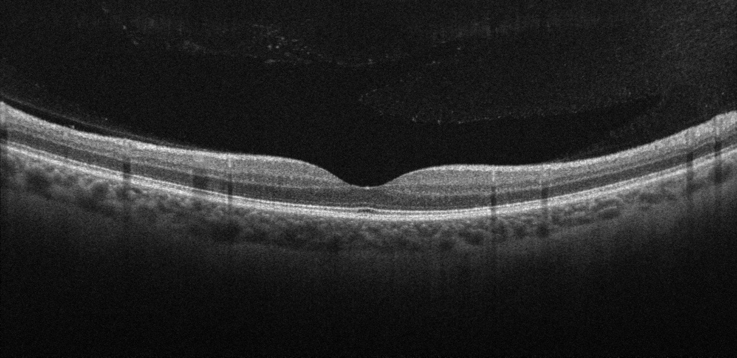OCT macular mostrando un corte transversal de las capas de la retina